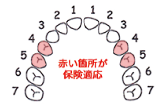 保険で白い歯が入れられるようになりました